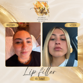 Classic Lip Filler (1ml)
