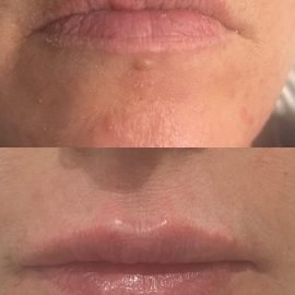 Classic Lip Filler (1ml)