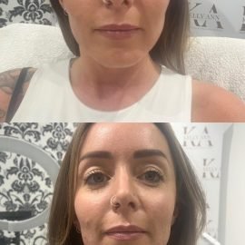 Cheek and Jawline Fillers (2 areas)