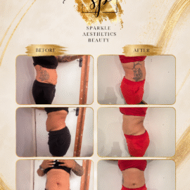 Ultimate Body Contouring (6 sessions)