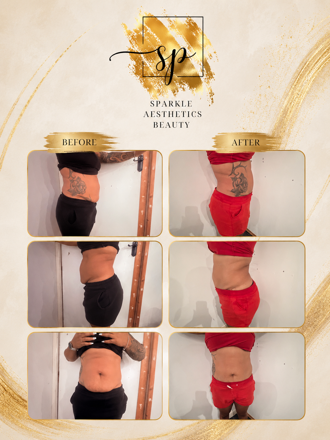 Ultimate Body Contouring (6 sessions)